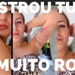 ANDRESSA URACH MOSTRA COMO ESTÁ SENDO O SEU PÓS OPERATÓRIO _ LIPEI TUDO MUITO ROXO _#andressaurach