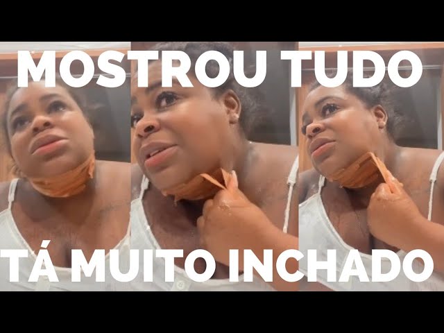 JOJO TODYNHO MSTRA O RESULTADO DA SUA CIRURGIA!! ESTOU INCHADA AINDA MAIS TÁ LINDO!#JOJOTODYNHO